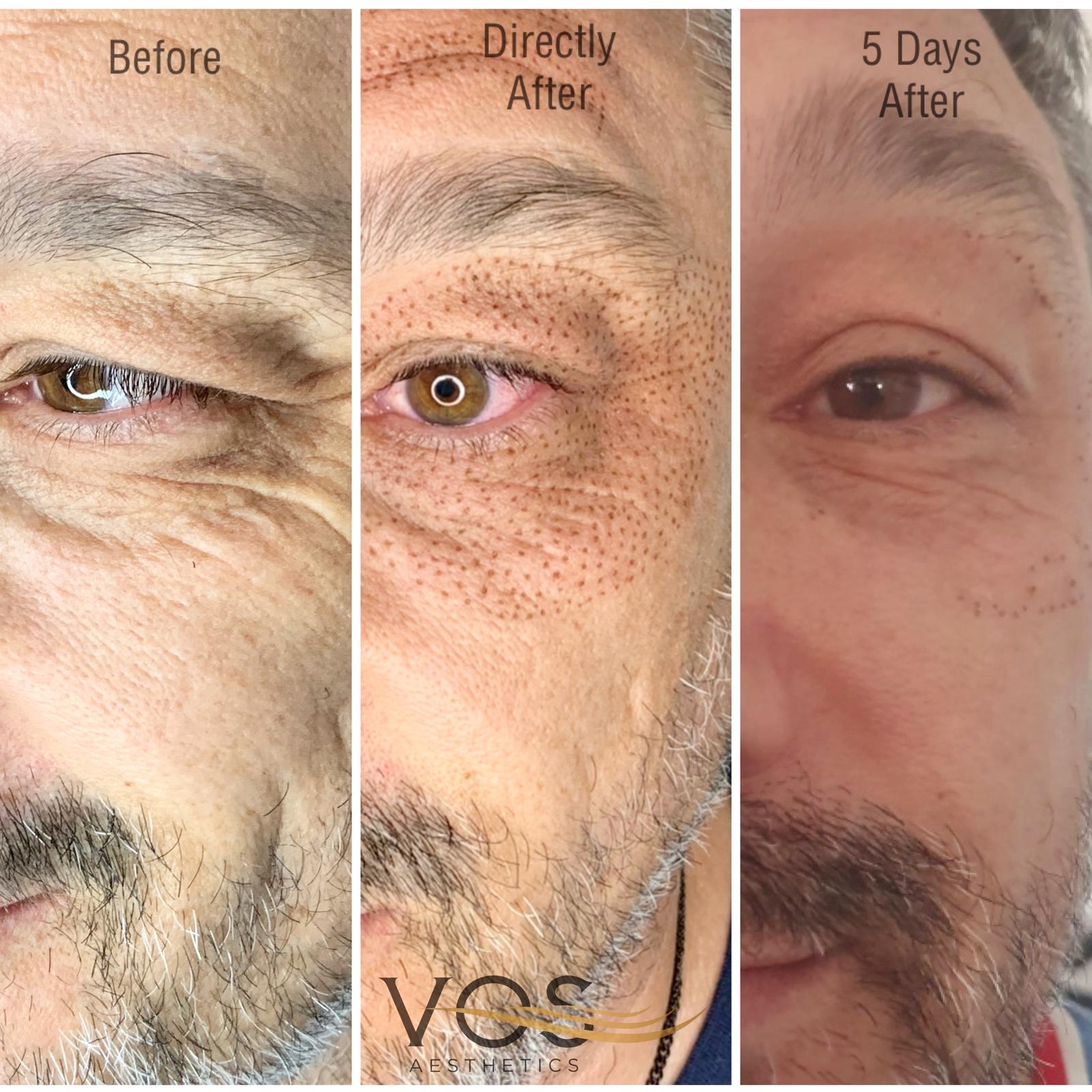 Fibroblast Plasma Therapy client photo sequence showing before, directly after and five days after