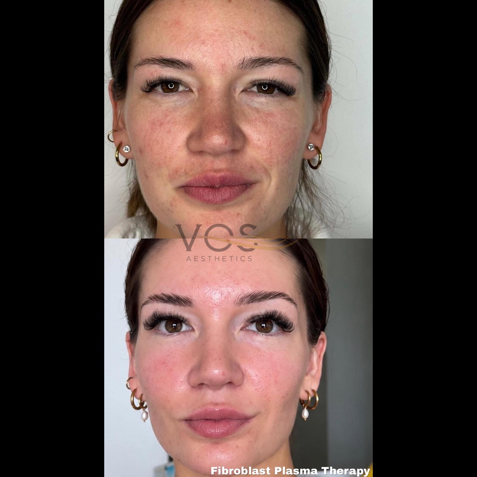 Two client portraits arranged as a before-and-after comparison for Fibroblast Plasma Therapy